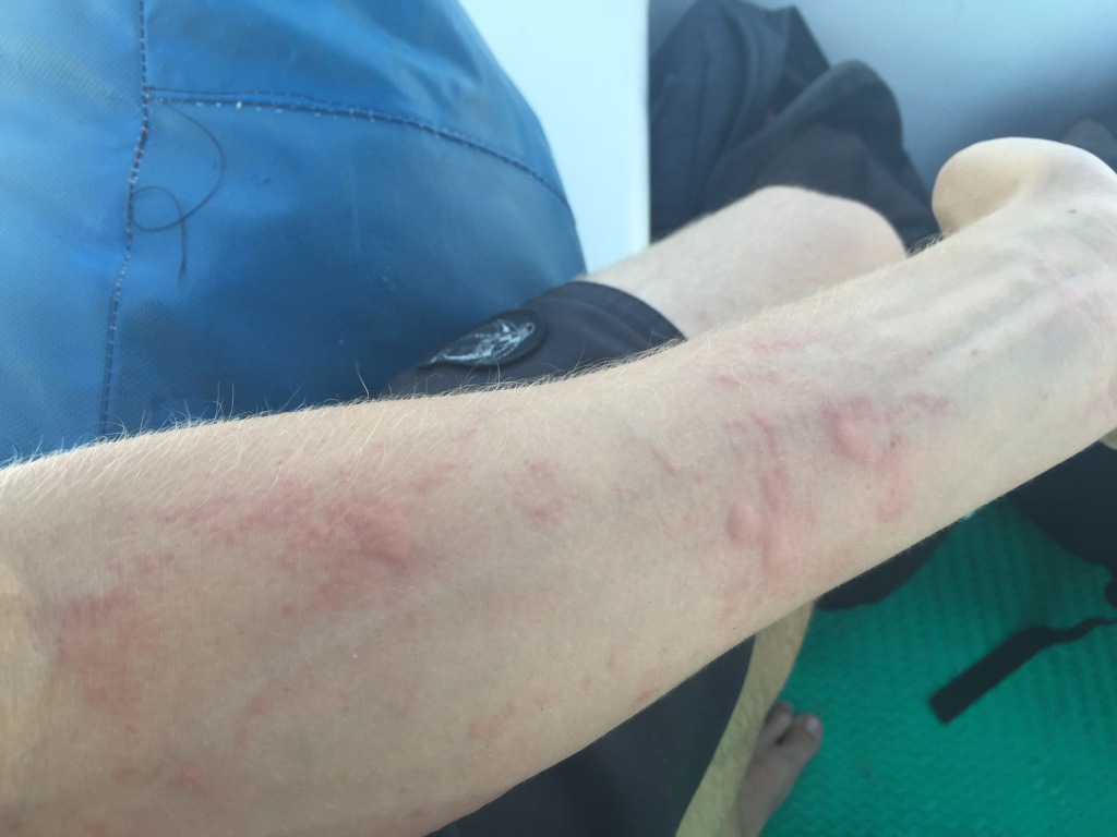 A forearm covered in jellyfish stings.
